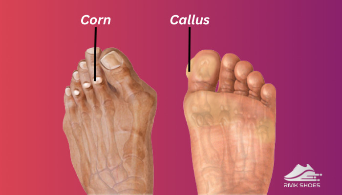 corn-and-calluses