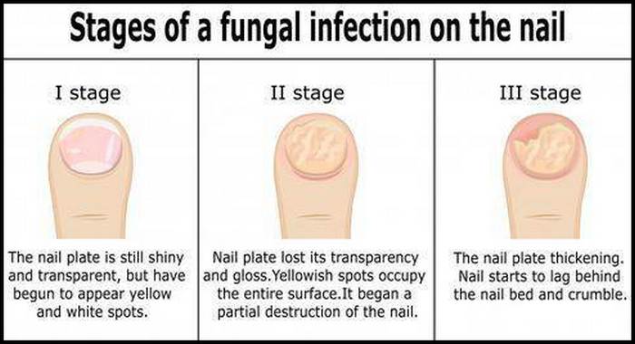 nail-infection