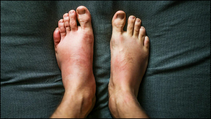 swelling-feet
