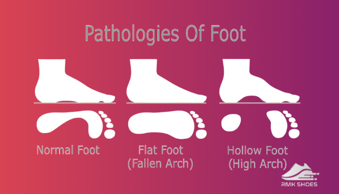 what-are-flat-feet