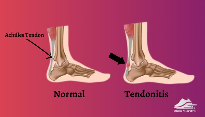 what-is-achilles-tendonitis